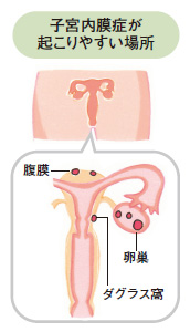 子宮内膜症が起こりやすい場所